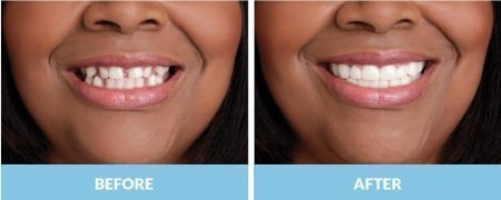 snap-on-smile4-1-2.jpg