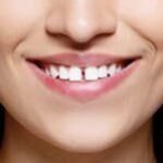 snap-on-smile-6-1.jpg